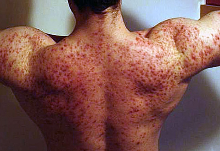 Side Effects of Steroids