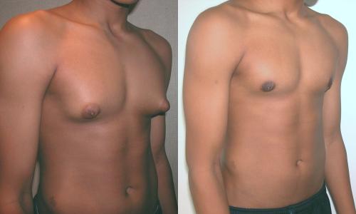Side Effects of Steroids